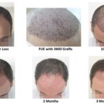 Hair Transplant Recovery Timeline: What to Expect Week by Week