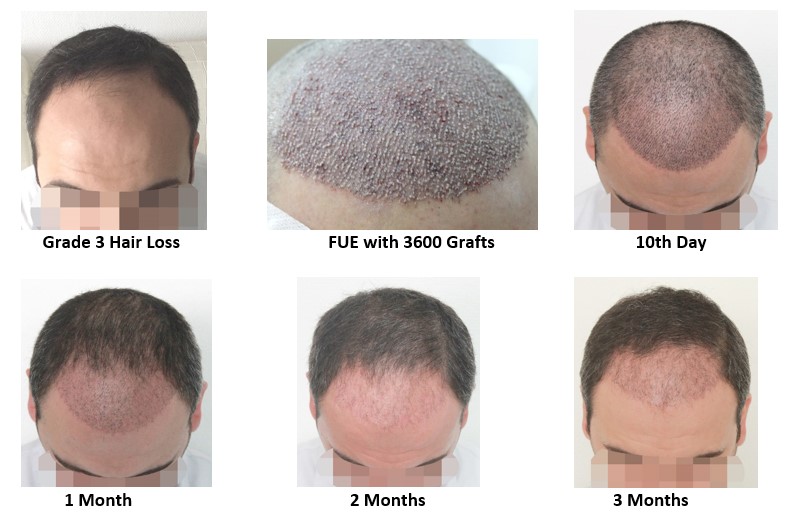 Hair Transplant Recovery Timeline: What to Expect Week by Week