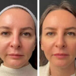 Mesotherapy in dubai,