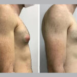 gynecomastia in dubai