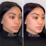 Strengthen skin support gently using Collagen-Enhancing Thread lift treatments in Dubai formulas