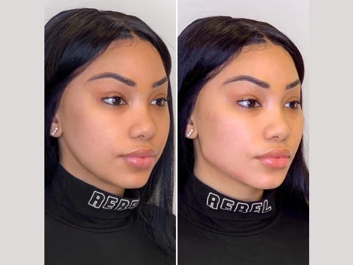 Strengthen skin support gently using Collagen-Enhancing Thread lift treatments in Dubai formulas