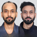 Hair Transplant in Islamabad: Expert Tips for Best Results