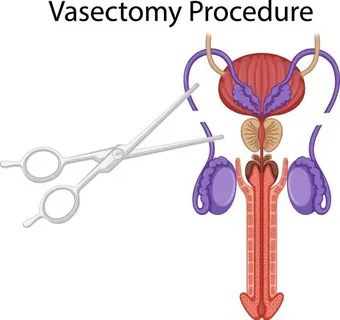 No Scalpel Vasectomy and Multimodal Pain Management