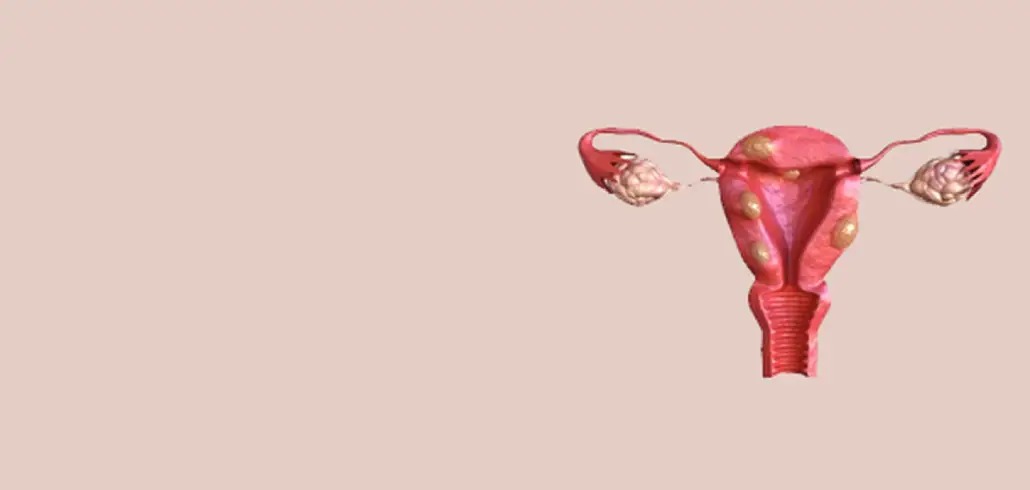 Uterine Fibroid Embolisation in Ahmedabad